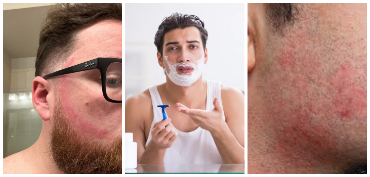 People having issues shaving with razors